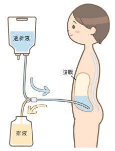 腹膜透析イメージ図