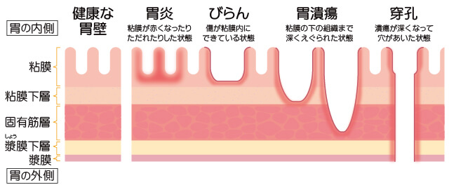 胃壁の構造と内壁の傷の種類